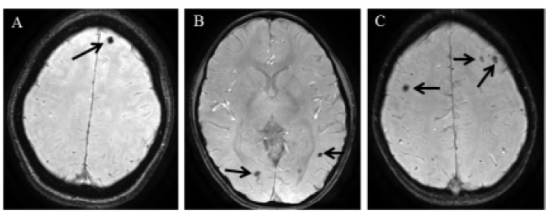 Magnetic resonance image of asymptomatic neurocysticercosis subjects showing cysticerci in the brain parenchyma. SWAN images at different sections show(A)single cyst, (B)two and (C)multiple cysts.