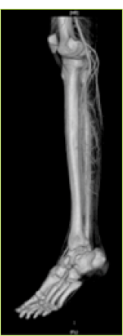CT angiography showing the perforators of the posterior tibial artery.