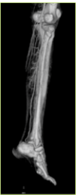 CT angiography showing the perforators of the peroneal artery.