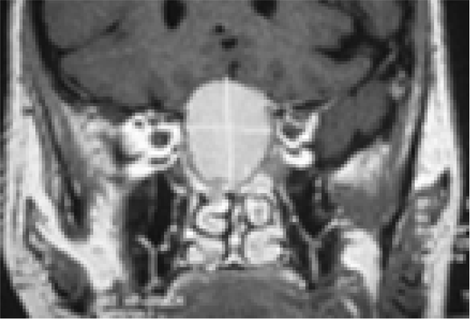 Coronal MRI brainshowing pituitary tumour