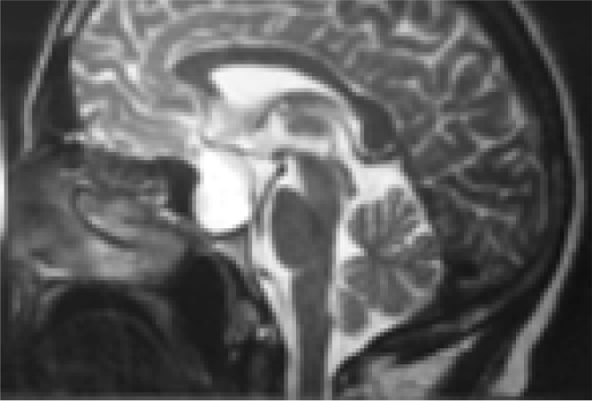 Sagittal MRI brainshowing pituitary tumour