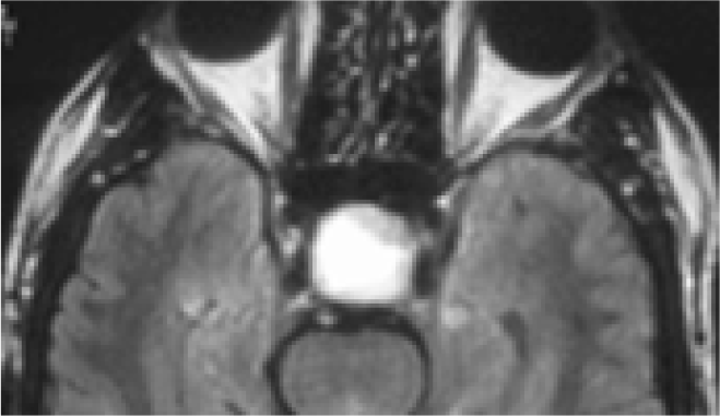 Sagittal MRI brain- showing pituitary tumour (pressing on optic chiasma)
