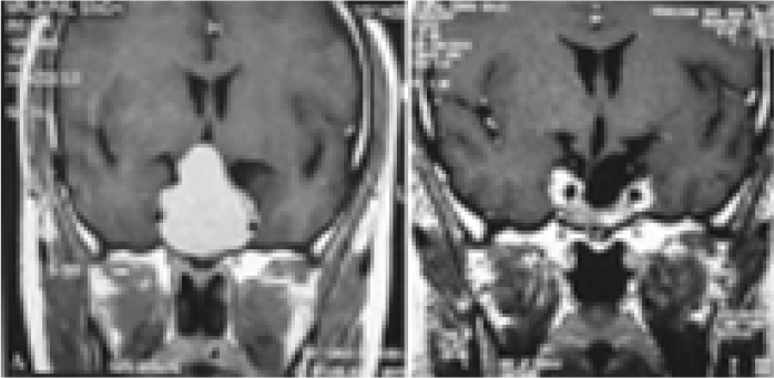 Pre op. MRI (a) and Post op. MRI (b) after 6 months