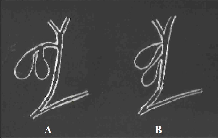 Diagramatic representation of vesical fellea duplex. There are two separate GB and cystic ducts. In Y type cystic ducts join together before joining common bile duct (CBD) (A) and in H-type the two cystic ducts join CBD separately (B).