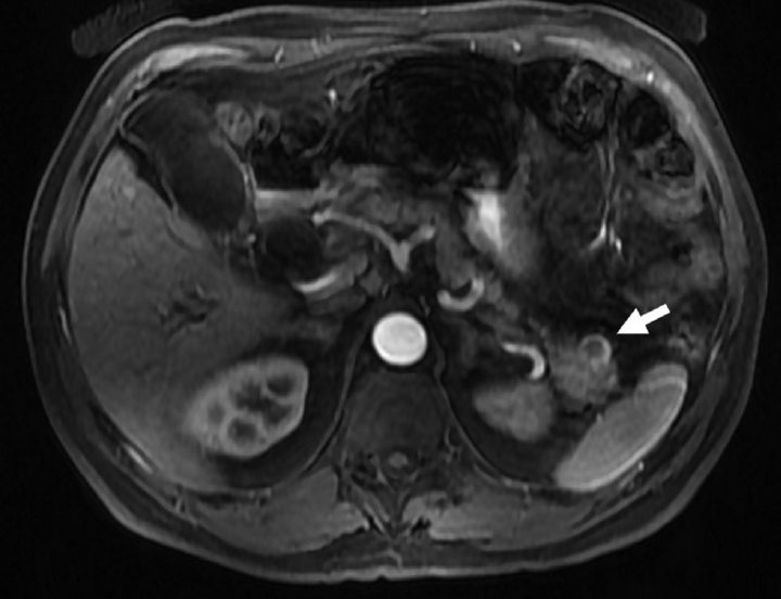 A 60-year-old male with incidental cystic pancreatic neuroendocrine tumor. Axial postcontrast T1-weighted image showing incidental unilocular cystic lesion (arrow) in the tail of the pancreas, showing peripheral arterial enhancement suggestive of cystic neuroendocrine tumor.