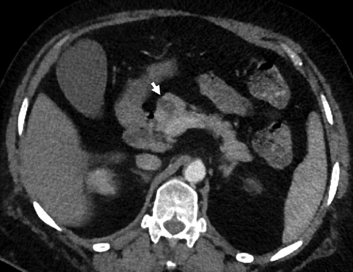 A 68-year-old-female with incidental serous cystadenoma. Axial contrast-enhanced computed tomography image showing polycystic lesion in the head of the pancreas (arrow) with thin internal septations in a case of serous cystadenoma.