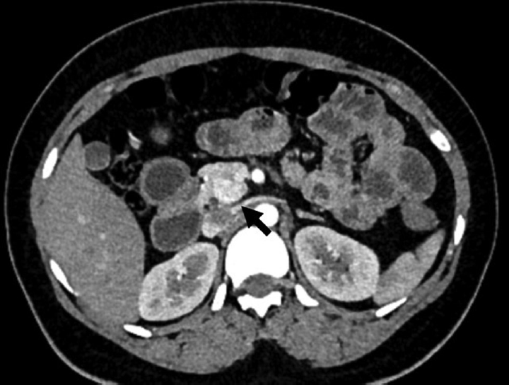 A 27-year-old female with incidental pancreatic neuroendocrine tumor. Axial contrast-enhanced computed tomography image showing incidental well-defined hypervascular lesion (arrow) in head uncinate of the pancreas.