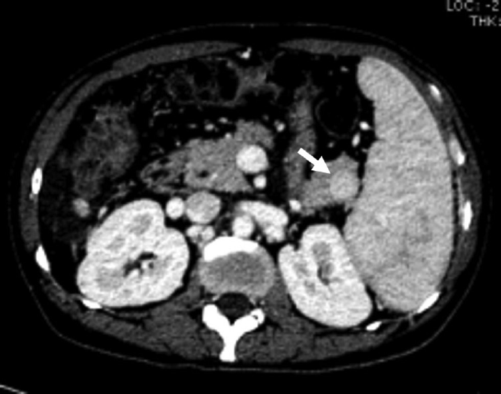 A 45-year-old-male with intrapancreatic spleen. Axial contrast-enhanced computed tomography image showing solid enhancing lesion (arrow) in the tail of the pancreas with enhancement similar to splenic parenchyma suggestive of intrapancreatic spleen.