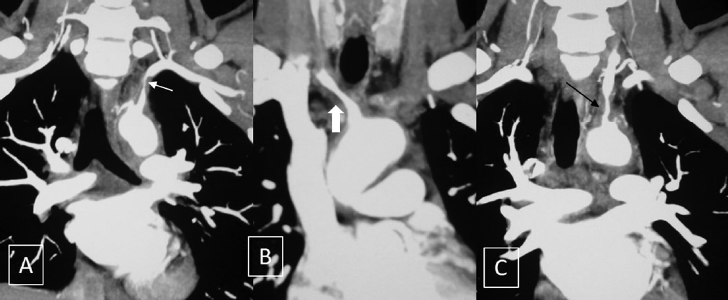 Short segment mural thickening with luminal narrowing is seen in left subclavian (white arrow in A), brachiocephalic (solid white arrow in B) and left common carotid (black arrow in C) arteries.