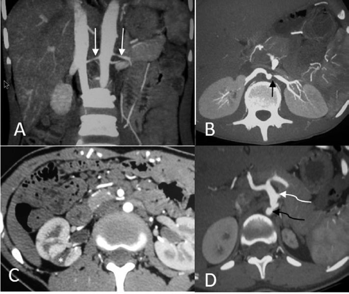 Diffuse mural thickening and narrowing of bilateral renal ­artery in a patient (A, white arrows). Another patient shows ostial stenosis of the origin of left renal artery (B, black arrow). Small renal infarct (*) is depicted in (C). A patient with abdominal involvement (D) shows thickening and stenosis of proximal abdominal aorta with ostial stenosis (curved black arrow) of origin of celiac trunk with ­poststenotic dilatation (curved white arrow).