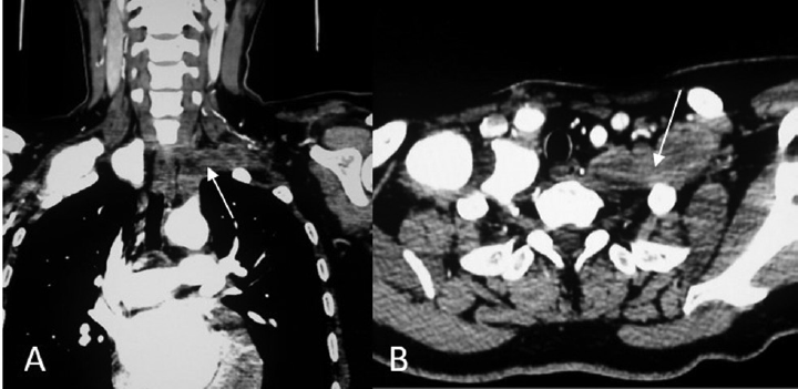 Coronal (A) and axial (B) images showing complete ­thrombotic occlusion of left subclavian artery (white arrows).