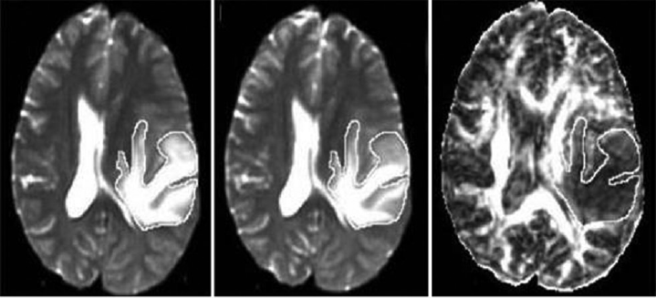 (A–C)Resolution of peritumoral edema (diffusion tensor magnetic resonance imaging [DT-MRI]) with dexamethasone treatment.(A) Before steroid therapy. (B) 24 hours after steroid therapy. (C) 72 hours after steroid therapy.