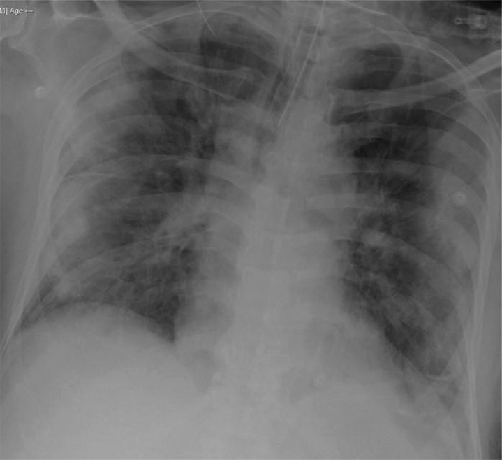 Definite COVID-19 pneumonia on CXR. Typical peripheral bilateral consolidation. CXR, chest X-ray.