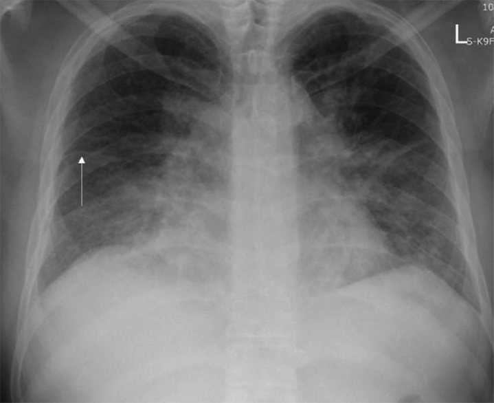 Indeterminate for COVID-19 pneumonia on CXR. Bilateral perihilar consolidation and GGO, with lamellar pleural effusion and fissural thickening (arrow) on right side. CXR, chest X-ray; GGO, ground glass opacity.