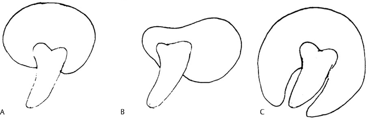 The central variety, in which the radiolucency surrounds just the crown of the tooth, with the crown projecting into the cyst lumen (A). In the lateral variety, the cyst develops laterally along the tooth root and partially surrounds the crown, (B) and the circumferential variant exists where the cyst surrounds the crown and extends down along the root (C).