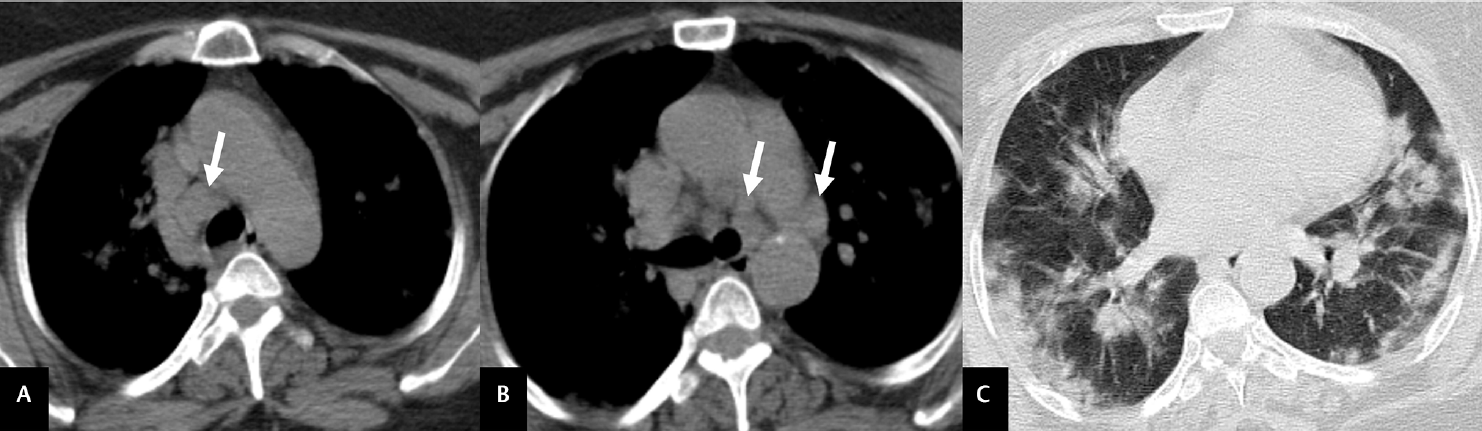 Axial CT images in mediastinal (A, B) and lung (C) windows show enlarged mediastinal lymph nodes (arrows in A and B), with multifocal ground-glass opacities (GGOs) in bilateral lungs.