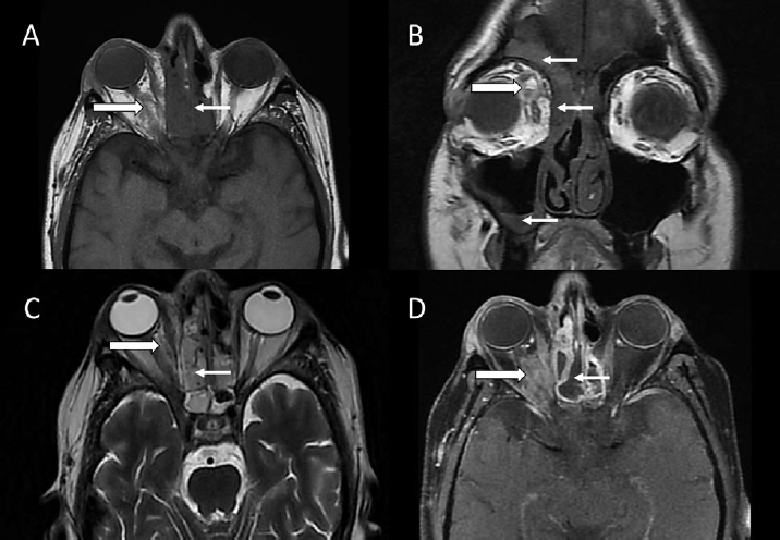 Axial T1-weighted (A), coronal T1-weighted (B), axial T2-weighted (C) and axial T1-weighted fat-saturated postcontrast (D) images of a 60-year-old diabetic female showing soft tissue in bilateral ethmoid sinuses, right frontal, and right maxillary sinuses (small arrows) with areas of nonenhancement on contrast administration. Extension of lesion seen in right orbit (large arrows) with intraorbital fat stranding and heterogenous postcontrast enhancement.