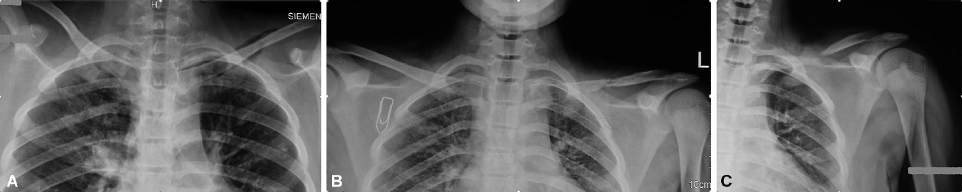 (A) Plain radiograph taken in medical intensive care unit did not reveal obvious bony abnormality. (B) Plain radiograph (taken 2 months later) showing areas of lysis in the middle third of left clavicle. (C) The radiograph (taken 2 months and 3 weeks later) revealed a pathological diaphyseal fracture with complete destruction of the middle third of left clavicle. There was also presence of surrounding osteopenia especially in the medial third clavicle.