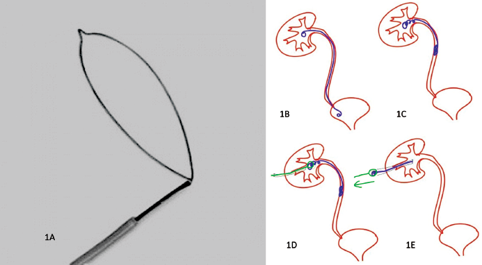 Photograph of a snare (A). Schematic line diagrams showing a normal stent (drawn in blue) position (B) and a migrated double J stent (C), introduction of a snare with sheath (drawn in black and green) (D), engagement of the stent (D), and retrieval by the snare (E).