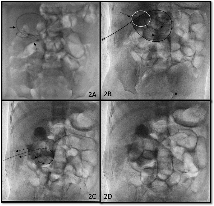 Fluoroscopic spot image (A) of the upper abdomen region shows coiled migrated double J stent (short arrows) in the right renal area. Loop of snare (arrows) engages the stent (circle) in the lower pole region (B). Stent is being pulled with snare (arrows) (C). Post-procedure nephrostogram spot image (D) shows completely removed stent and no leakage of contrast from pelvicalyceal system.