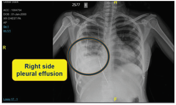 Chest X-Ray showing right lower zone opacity with pleural effusion.