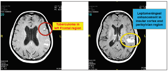 Post-contrast magnetic resonance imaging (MRI) brain showing tuberculoma in left inferior frontal gyrus with leptomeningeal enhancement.