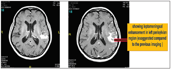 Follow-up MRI showed new tuberculoma and exaggerated leptomeningeal enhancement in the left temporal region.