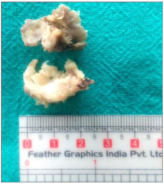 Gross photograph of cut surface of bilateral tonsils revealing gray white with few chalky white areas.