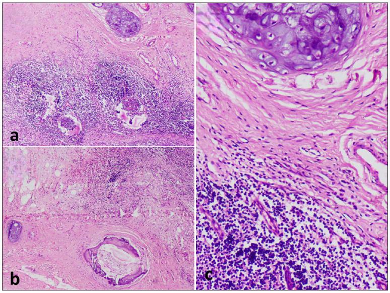 Microphotograph revealing (a) lymphoid hyperplasia, areas of fibrosis, and islands of mature hyaline cartilage (H&E; 40x); (b) occasional focus of mature bone formation (H&E; 40x) and (c) high power view of cartilage (H&E; 100x). H&E: Hematoxylin and eosin stain.