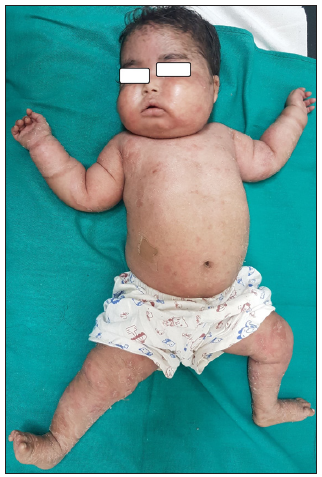 A 9-month-old male infant with cushingoid features and erythroderma due to dermatophytosis.