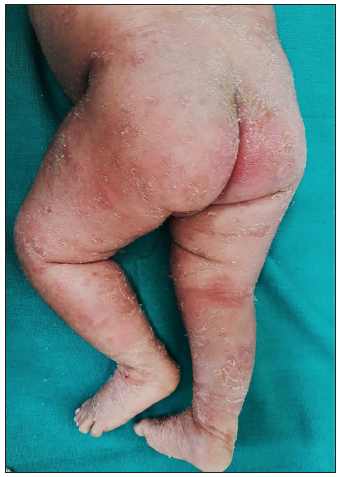 Generalized dermatophytosis (erythroderma) involving entire body.