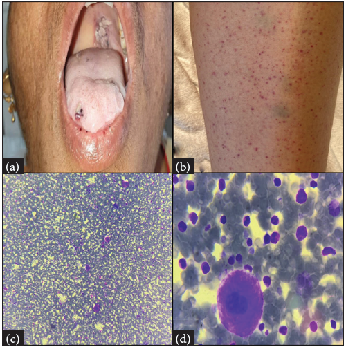 (a–b): Clinical photograph showing petechiae over (a) Lower lip; (b) Lower limb; (c–d): Bone marrow aspirate showing trilineage hematopoiesis with increased Megakaryocytes (c) 100x and (d) 1000x.
