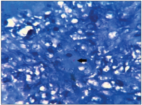 AFB positivity in a necrotizing granuloma in a case of carcinoma cervix (ZN stain ×400). Pink, rod shaped acid fast bacilli , depicting AFB positivity (Black arrow). (ZN: Ziehl-Neelsen; AFB: Acid Fast Bacilli)