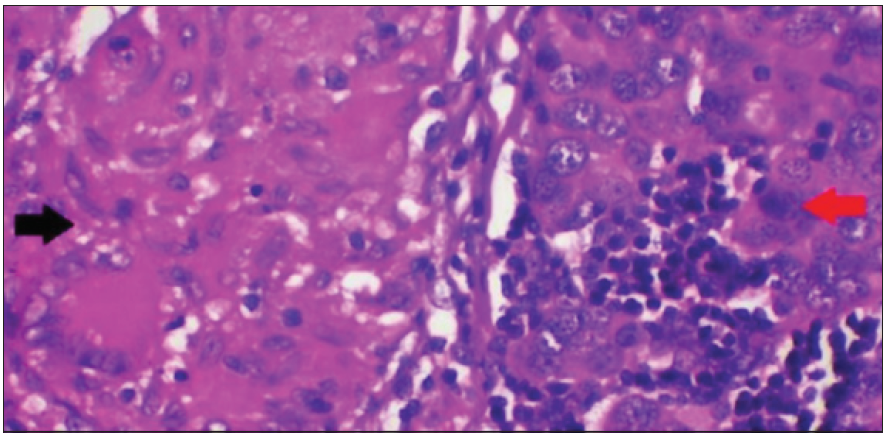Epithelioid granuloma (black arrow) with invasive breast carcinoma (red arrow) (Haematoxylin & Eosin ×400).