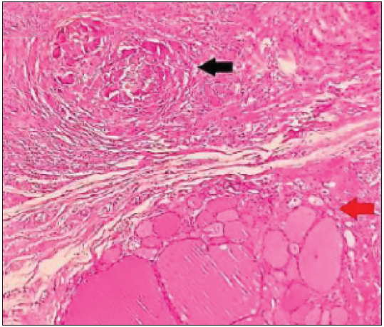 Epithelioid granuloma (black arrow) with encapsulated follicular patterned neoplasm thyroid (red arrow) (Haematoxylin & Eosin ×100).