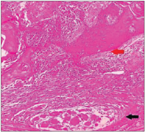Epithelioid granuloma (black arrow) with oral squamous cell carcinoma (red arrow) (Haematoxylin & Eosin ×100).