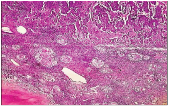 Necrotizing granuloma in lymph nodes with metastatic deposits from invasive breast carcinoma (Haematoxylin & Eosin ×40).