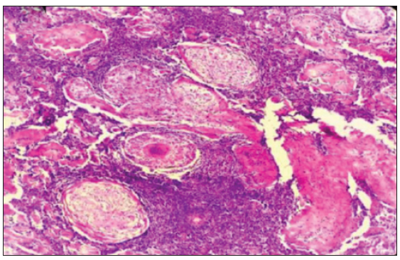 Necrotizing granuloma in lymph node without metastatic deposits in a case of oral squamous cell carcinoma (Haematoxylin & Eosin ×100).