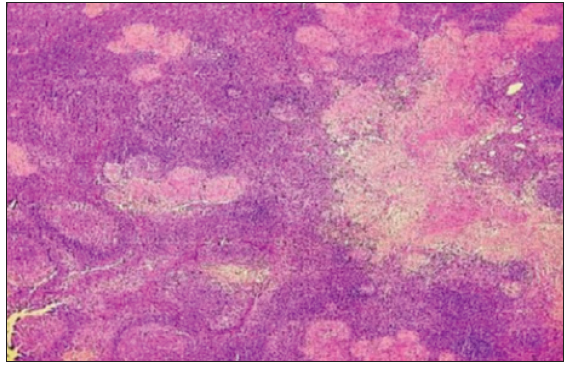 Necrotizing discrete tuberculoid-like granuloma in lymph nodes (Haematoxylin & Eosin ×40).