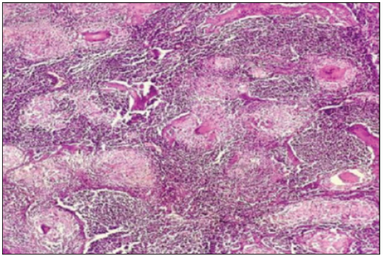 Nonnecrotizing coalescent sarcoid-like granuloma in lymph nodes (Haematoxylin & Eosin ×100).