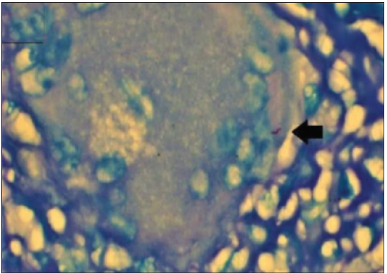 AFB positivity in a necrotizing granuloma in a case of invasive breast cancer (ZN stain ×1000; oil immersion). Pink, rod shaped acid fast bacilli , depicting AFB positivity (Black arrow). (ZN: Ziehl-Neelsen; AFB: Acid Fast Bacilli)