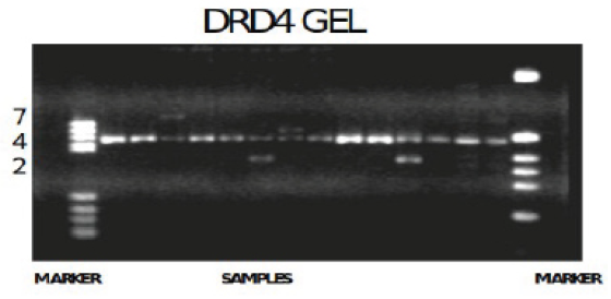 Variable Number Tandem Repeats (VNTR) polymorphism fragments of DRD4 7repeat allele gene photograph. Lanes 1 2 3 4 5 6 7 8 9 10 11 12 13 14 15 16 This is the photograph of the 2.5% agarose gel showing the DRD4 7R gene alleles under ultraviolet illumination, after the completion of gel electrophoresis. The sizes were determined after comparing the allele size with standard marker which was loaded in the agarose gel, along with the amplified polymerase chain reaction (PCR) products of the subjects. In the above photograph, the marker is present on the left- and right-hand side. Lanes 1,16- Bands were compared with standard DNA marker 1-PBR, 16- Haelll Digest Lanes 2,3,5,6,9,10,11,13,14,15- genotype of 4 4 Lane 4 ----------------------------- genotype of 4 7 Lanes 7, 12 ----------------------------- genotype of 2 4 Lane 8 ----------------------------- genotype of 2 2