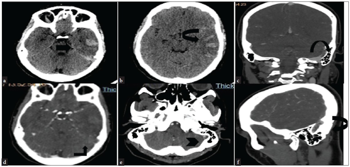 NCCT head (a and b) axial section—hyperdense contents (black arrow) (suggestive of SAH) involving the sylvian fissure and sulcal spaces and parenchyma of the left temporoparietal lobe. (c, d, e, and f)—CT angiography second phase—hypodense partially occlusive patchy and linear areas of filling defects suggestive of thrombus seen in the left sigmoid sinus (black arrowhead in e). NCCT: Non-contrast computed tomography, SAH: Sub-arachnoid hemorrhage.