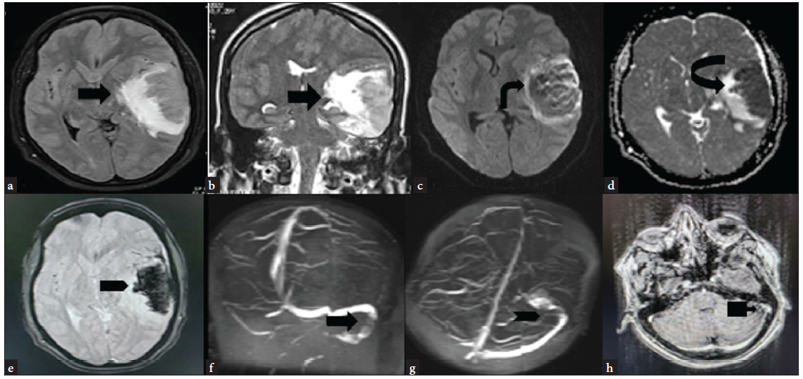 MRI (a and b) FLAIR axial and T2 coronal—hyperintense area of altered signal intensity involving the cortex and underlying white matter of the left temporoparietal lobe (black arrow). (c and d) DWI and ADC maps—lesion is showing a patchy area of restriction of diffusion with corresponding reduced ADC values (black arrow). (e) GRE axial—diffuse are of signal loss/blooming as seen suggestive of intraparenchymal hemorrhage (black arrow). (f and g) 2D TOF MRV coronal and axial—hypointense filling defects with peripheral hyperintensity within the left sigmoid sinus (black arrow) (black arrowhead). (h) Gadolinium-enhanced T1 Axial—central filling defect in left sigmoid sinus with peripheral post-contrast enhancement (black arrow). FLAIR: Fluid-attenuated inversion recovery, DWI: Diffusion-weighted imaging, ADC: Apparent diffusion coefficient, GRE: Gradient recalled echo, TOF: Time-of-flight, MRV: Magnetic resonance venography.