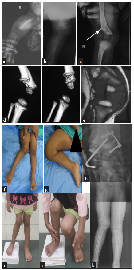 Illustrative case 1: (a) Anteroposterior view of right knee joint at age 10 days when septic arthritis of the joint was diagnosed. (b). Partial loss of epiphysis visible by 6 months. (c) Typical unicondylar loss of distal femur and adjacent metaphysis on lateral side at 12 months. Metaphyseial spur could also be appreciated (white arrow). (d) Computed tomography (e) MRI images of the lesion. (f,g) Clinical deformity and knee range of movement at 1.5 years. (h) Combined procedure distal medial closing wedge femoral osteotomy and tension band plating of medial side. (i,j,k) Follow- up 31 months – clinical and radiological findings of recurrent deformity.