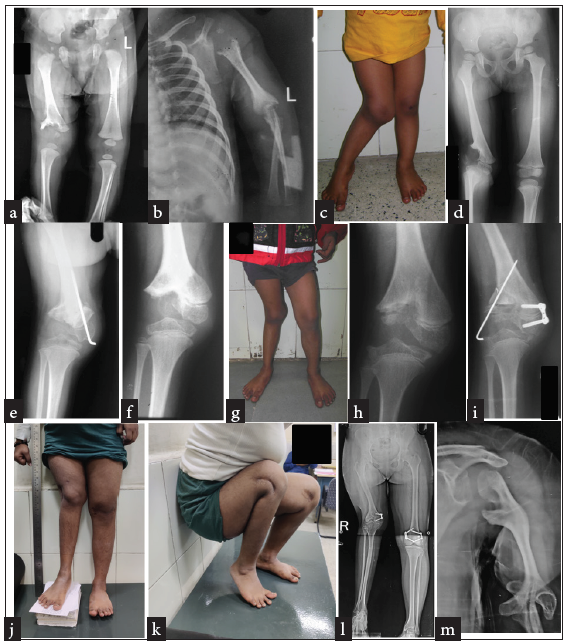 Illustrative case 2: (a,b) severe neonatal sepsis with multifocal joint involvement. Radiographs at 2 months. Lesions are obvious in the right knee and lateral metaphysis, left shoulder, and elbow region. (c,d) Child at 2.5 years of age. Clinical deformity and radiological appearance. (e,f) Medial closing wedge osteotomy of the distal femur was performed at age 3 years. Healed osteotomy and corrected limb alignment at this stage. (g,h,i) Child at 6 years. The deformity had recurred. Partial regeneration of the lateral condyle is obvious. There was evidence of an eccentric physeal bar in the distal femur which was excised and a medial side tension band plating was added. (j,k) Follow up at skeletal maturity at age 14 years. Residual valgus at knee and limb length discrepancy. Knee range of movements fairly preserved. (l,m) Scanogram of the limb and the fate of other affected joints at the same follow-up.