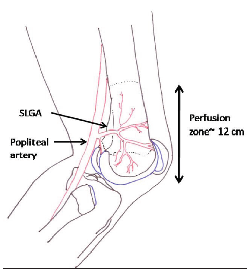 The area supplied by superior lateral genicular artery (SLGA). It is branch of popliteal artery and arises on the posterior aspect of knee. Approximately 12 cm of lateral half of distal femur is completely supplied by this vessel.