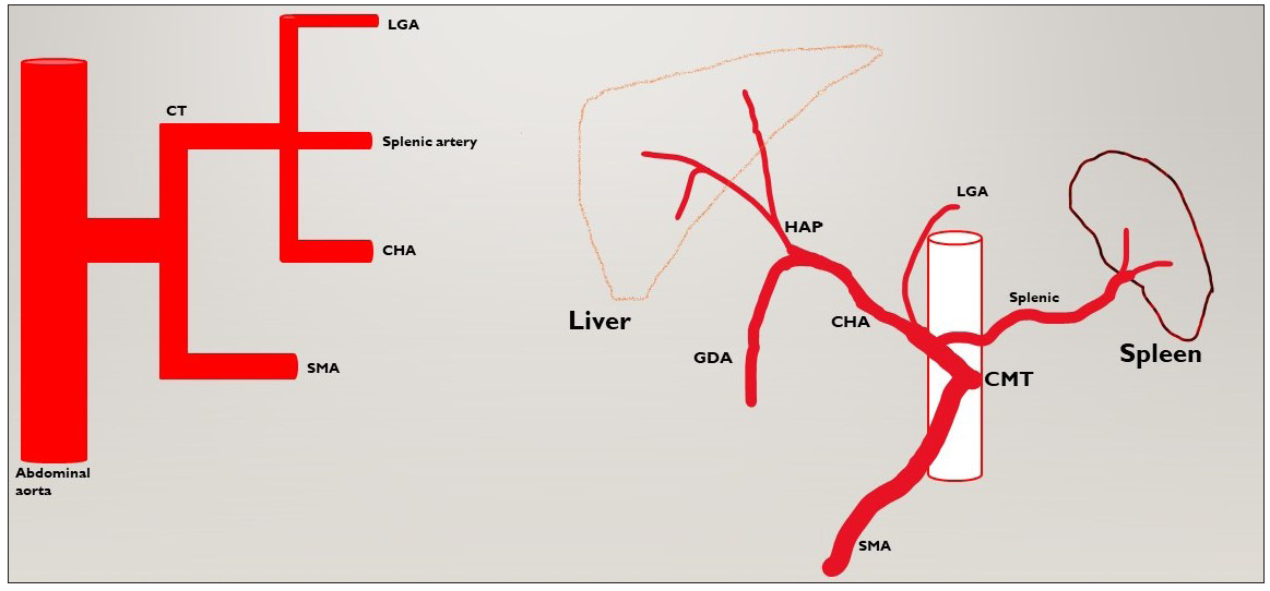 Depicting the common origin of coeliacomesenteric trunk. CT: Coeliac trunk, LGA: Left gastric artery, CHA: Common hepatic artery, SMA: Superior mesenteric artery, GDA: Gastroduodenal artery, HAP: Hepatic artery proper, CMT: celiacomesenteric trunk