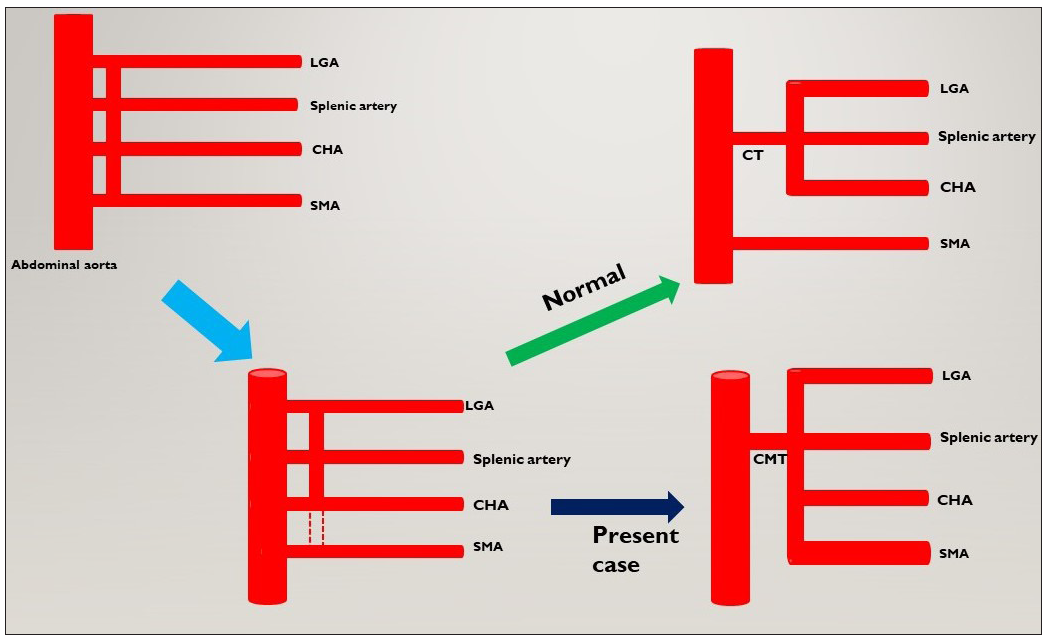 Depicting short-type coeliacomesenteric trunk. CT: Coeliac trunk, LGA: Left gastric artery, CHA: Common hepatic artery, SMA: Superior mesenteric artery, GDA: Gastroduodenal artery, HAP: Hepatic artery proper, CMT: celiacomesenteric trunk