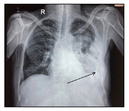 Chest-X-ray showing massive pleural effusion with blunting of costophrenic angle on the left side (black arrow).